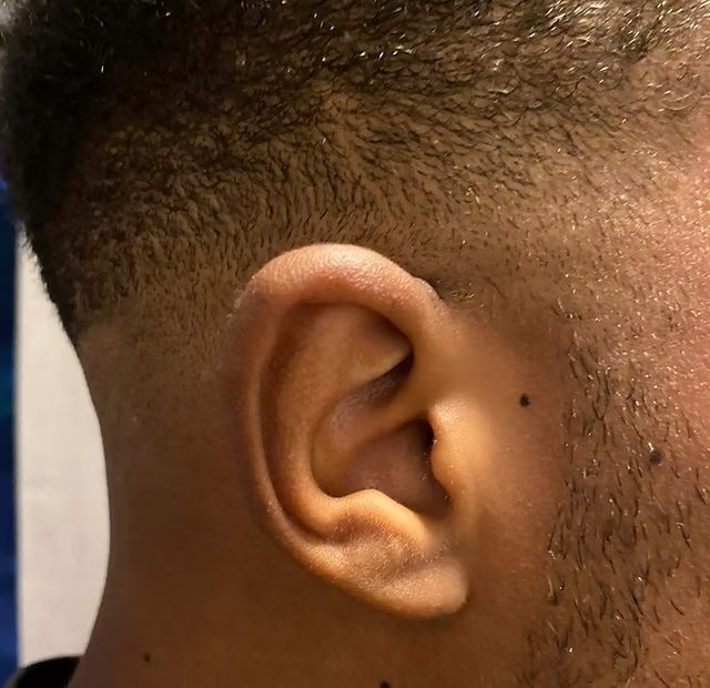 Close-up of an ear for auricular reflexology